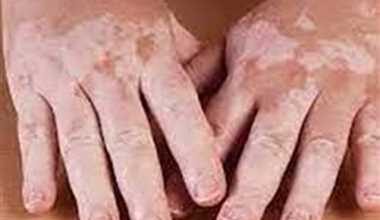 Sparsh Leprosy Awareness Campaign : 13 फरवरी तक जागरूकता रथ द्वारा गांव गांव में भ्रमण कर ग्रामीणों को किया जाएगा जागरूक